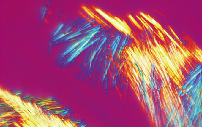 简单的痛风检查